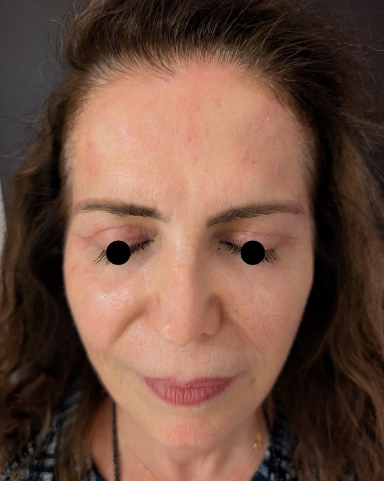 Upper blepharoplasty one month after, downward gaze