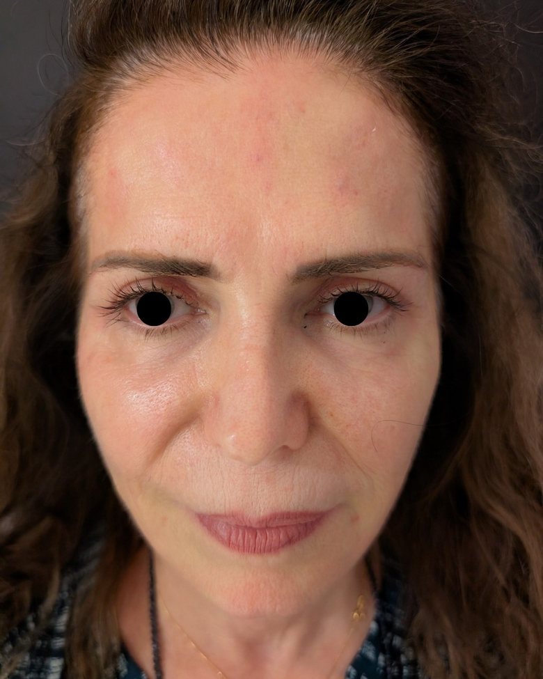 Upper blepharoplasty after, frontal