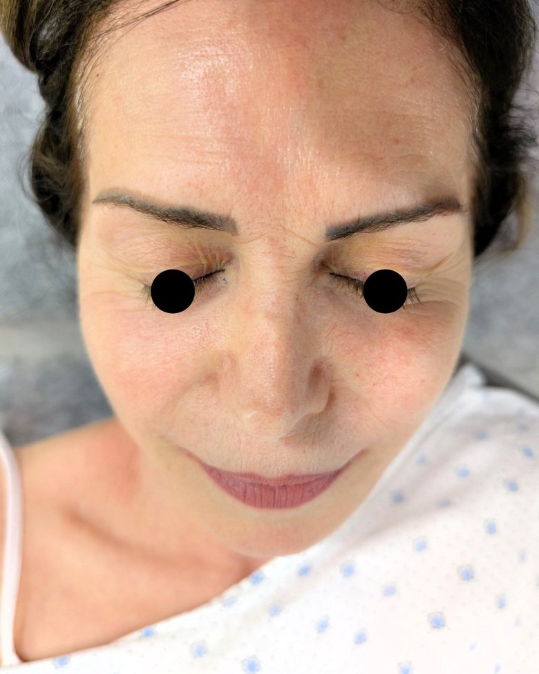 Upper blepharoplasty before, downward gaze