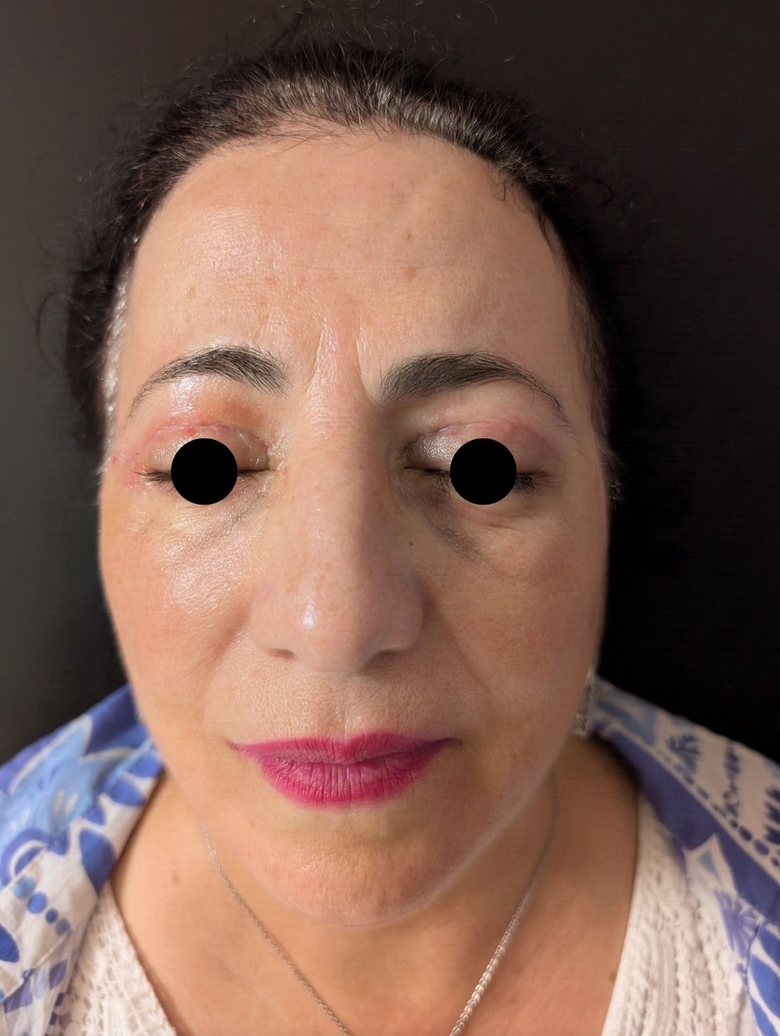 After upper and lower blepharoplasty