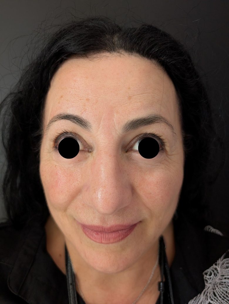 Before upper and lower blepharoplasty