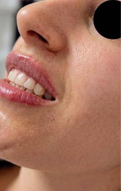 Lip and perioral filler after