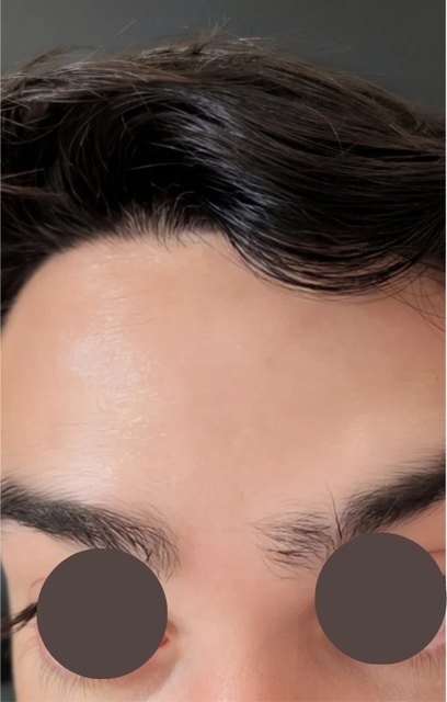 Forehead lines after