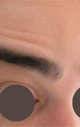 Forehead lines before