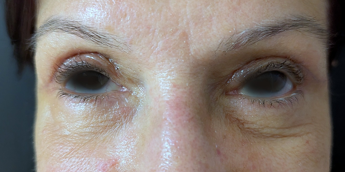 Upper blepharoplasty sixteen days after surgery, both eyes, frontal