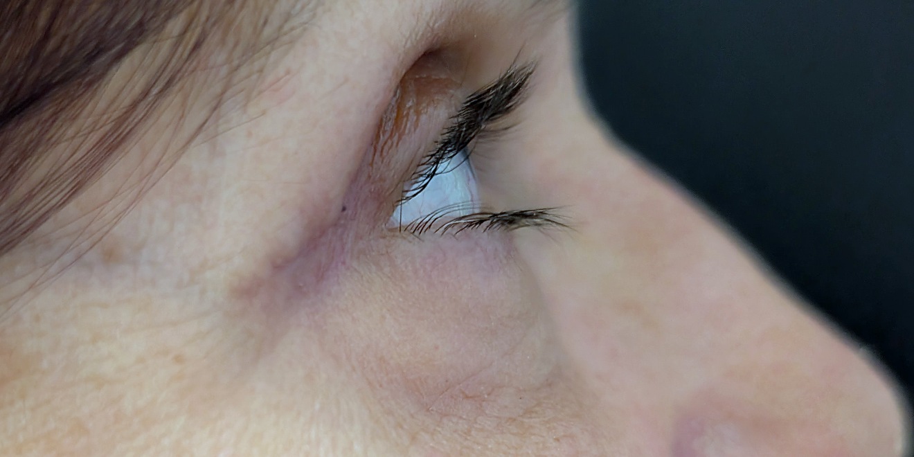 Upper blepharoplasty sixteen days after surgery, side view