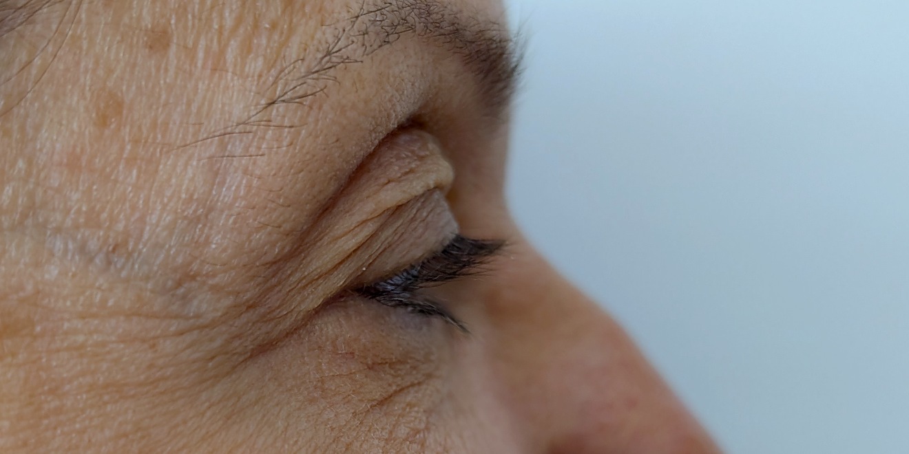 Upper blepharoplasty before surgery, side view